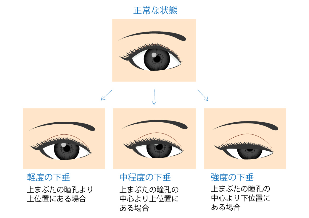 眼瞼下垂の症状　図解