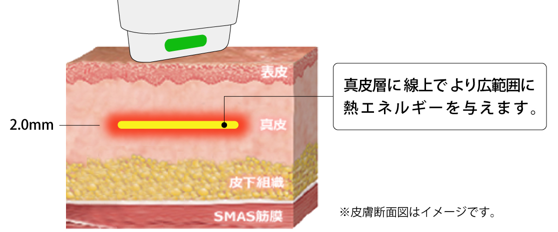 真皮層に線状でより広範囲に熱エネルギーを与える図解