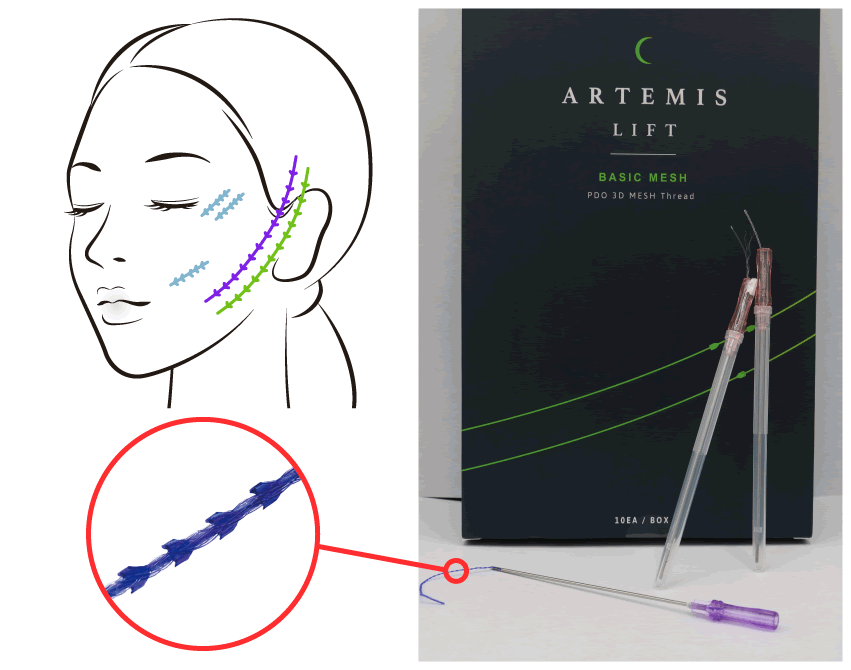アルテミスリフトの糸と施術位置図解