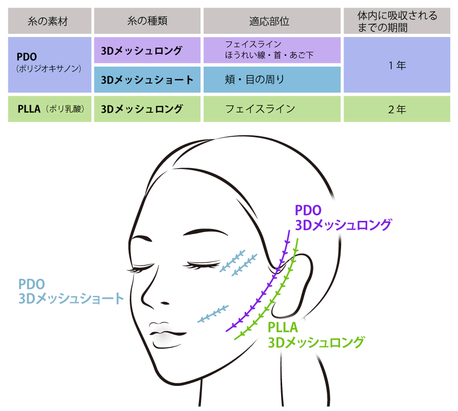 糸の種類と適用の図解