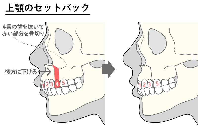 上下セットバック（上顎のセットバック）図解1