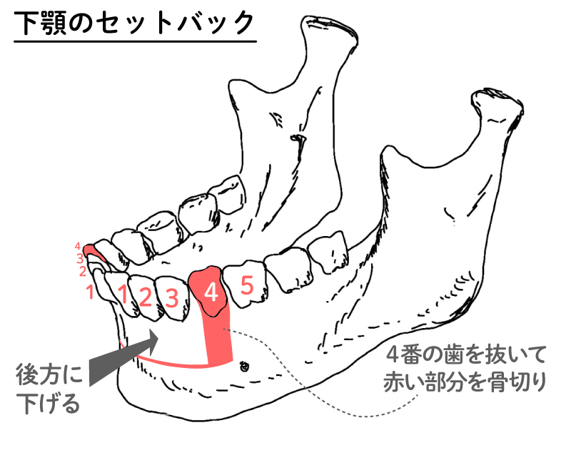 上下セットバック（下顎のセットバック）図解1