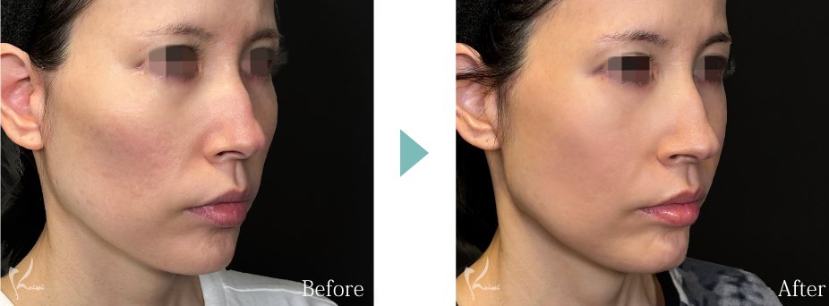 頬骨骨切り(頬骨形成術)の症例1