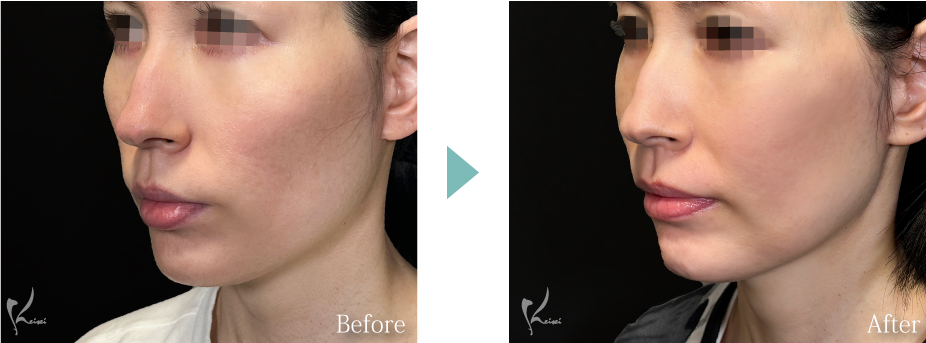 頬骨骨切り(頬骨形成術)の症例2