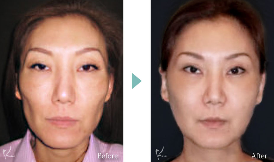 頬骨骨切り(頬骨形成術)の症例4