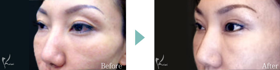 頬骨骨切り(頬骨形成術)の症例3