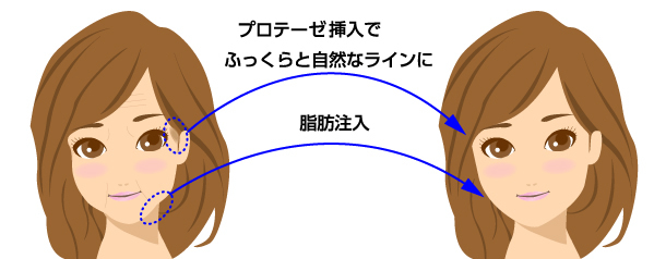 プロテーゼ挿入でふっくらと自然なラインにの図解