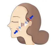頬骨体部（前面頬骨形成術）側面図解