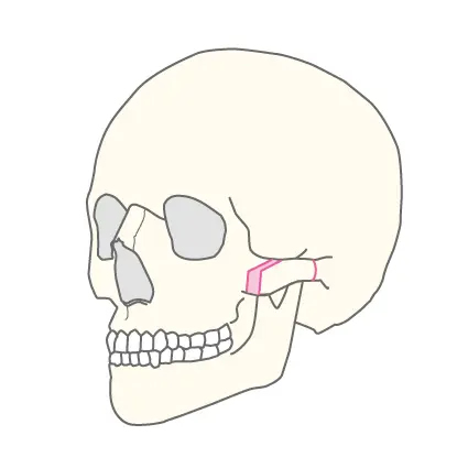 複合型頬骨形成術図解1