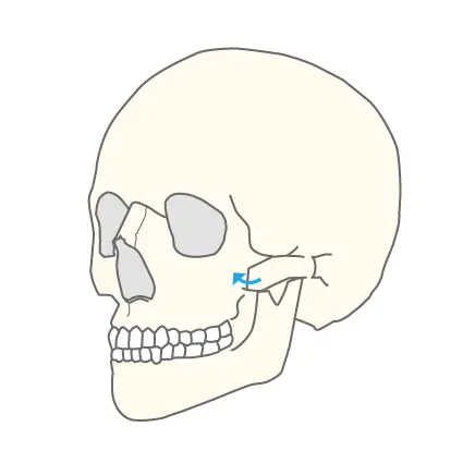 複合型頬骨形成術図解2