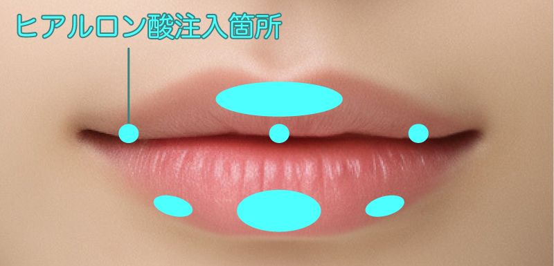 ヒアルロン酸の注入箇所図解