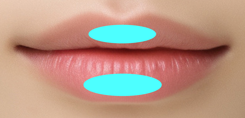 ボリュームアップの注入箇所図解