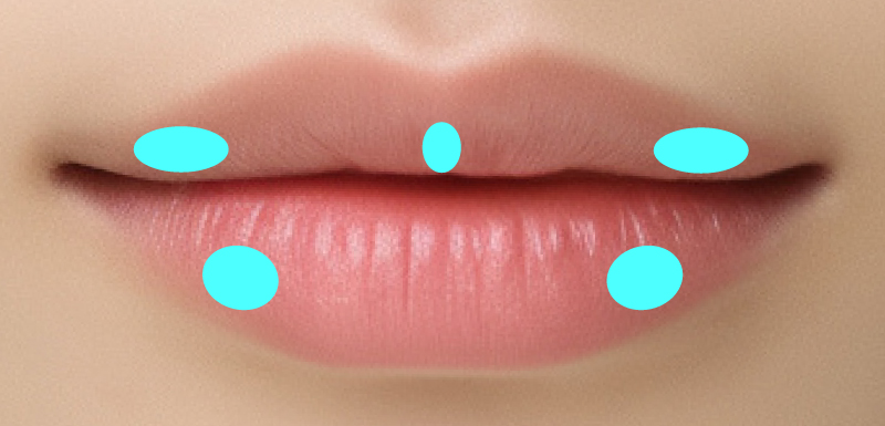 M字リップの注入箇所図解