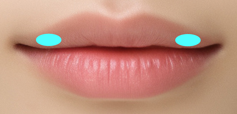 アヒル口の注入箇所図解