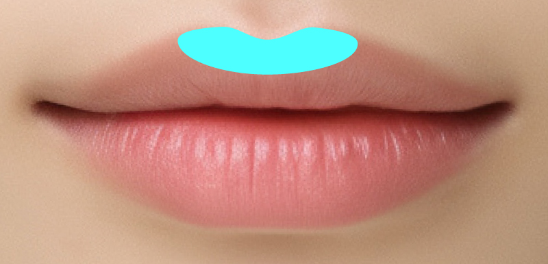 切らない人中短縮（リップリフト）の注入箇所図解