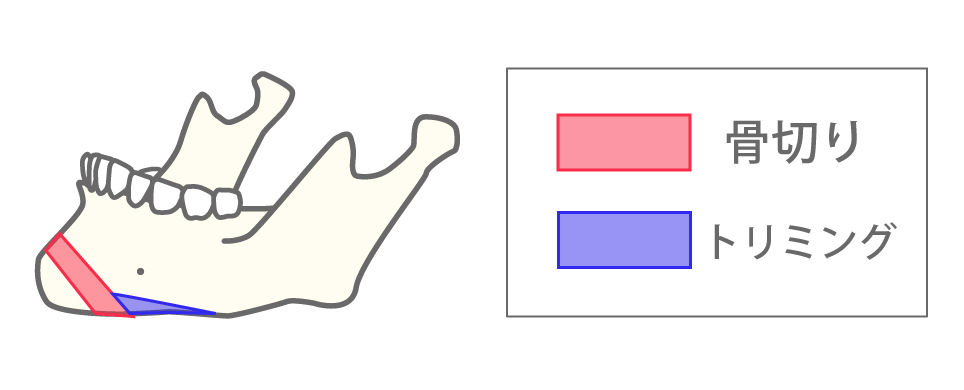 中抜き法（顎短縮、顎前進、顎後退）図解