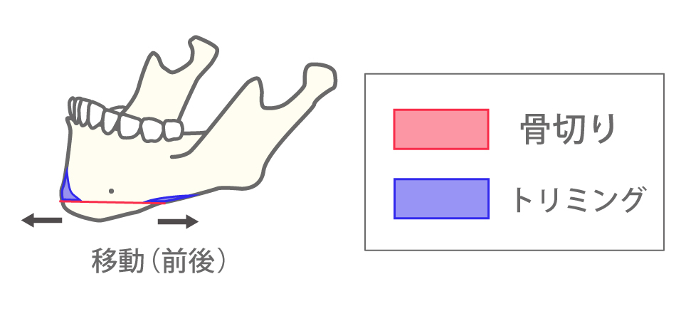 水平骨切り（顎前進、顎後退、左右移動）図解1