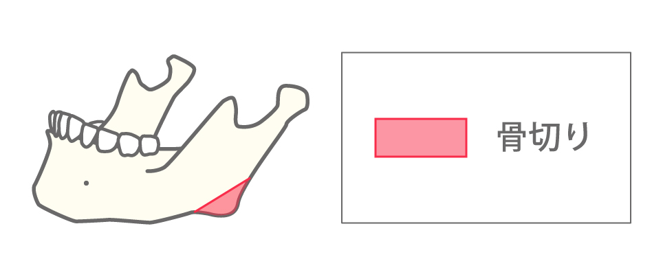 エラ骨切り（下顎角形成）従来のエラ削り図解