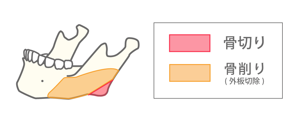 拡大下顎角形成（下顎角骨切り＋下顎枝・体部外板切除）図解
