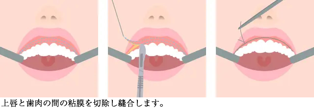 上口唇粘膜切除術の図解