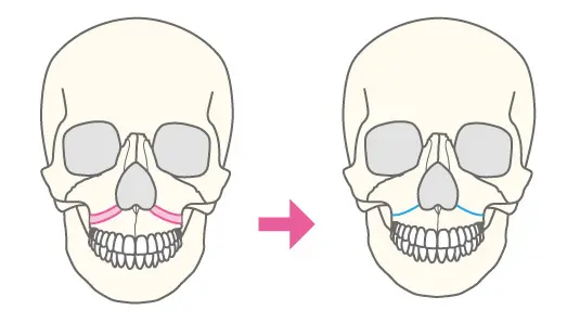 ルフォー（LeFortl型）骨切り術（中顔面短縮術）の図解