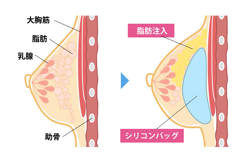 ハイブリッド豊胸の図解