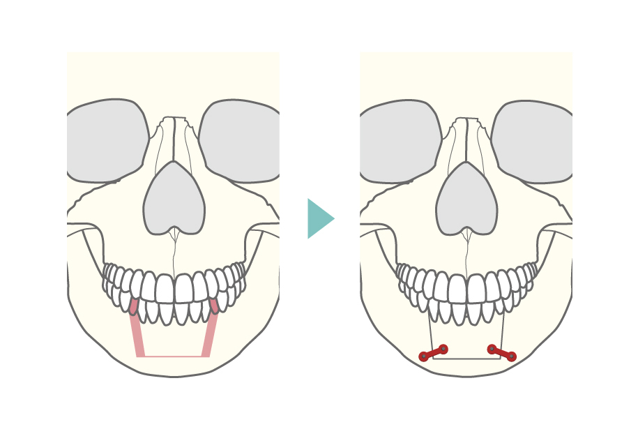 下顎セットバック術式イメージ図解1