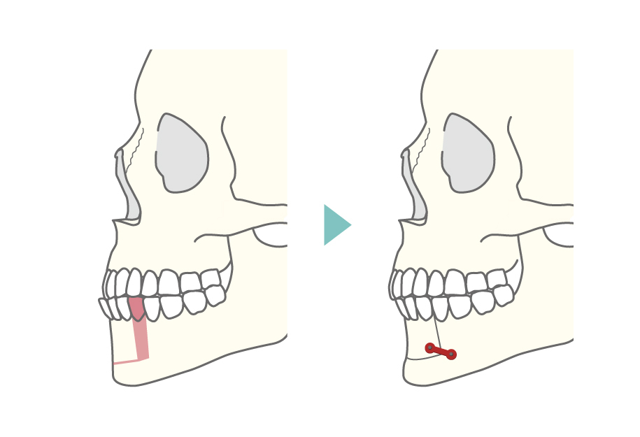 下顎セットバック術式イメージ2
