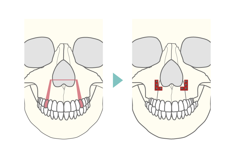 上顎セットバック（上顎分節骨切り術）図解1