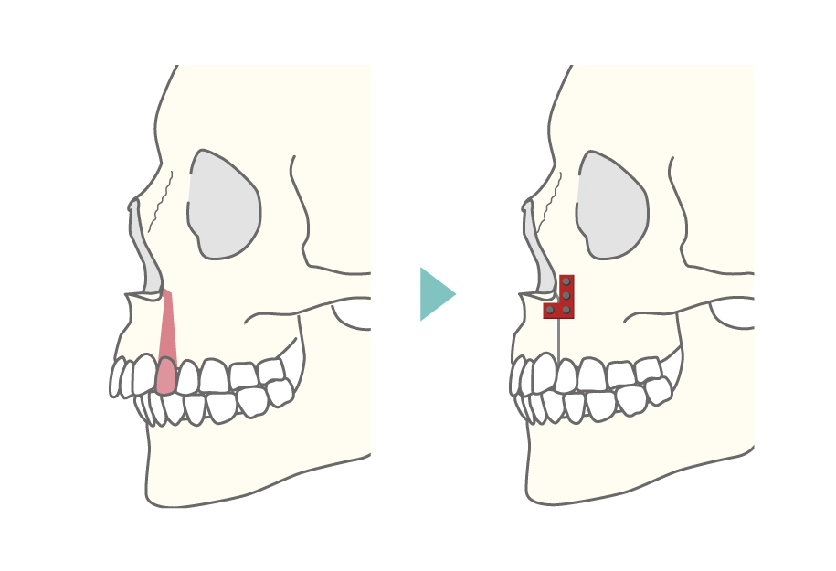 上顎セットバック（上顎分節骨切り術）図解2