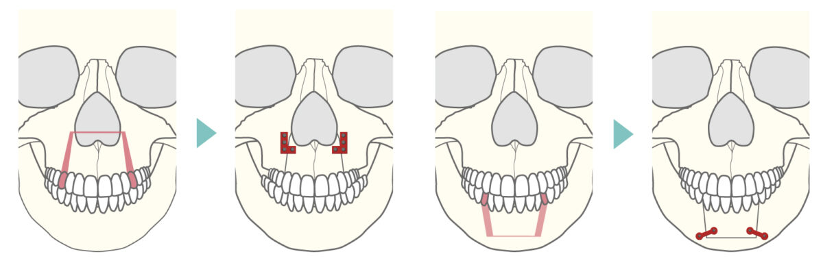 上・下顎分節骨切り術（上下セットバック）図解1