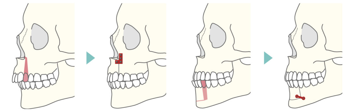 上・下顎分節骨切り術（上下セットバック）図解2