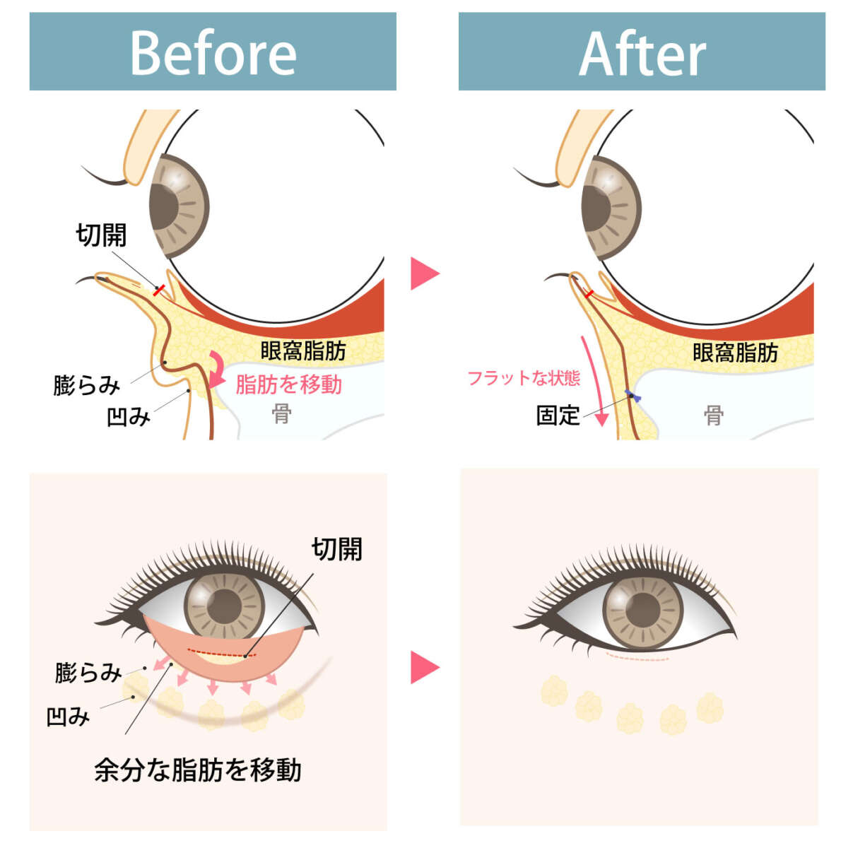 脂肪再配置（裏ハムラ）の術前術後の図解