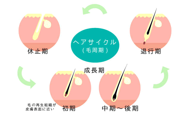 医療レーザー脱毛の仕組みの図解