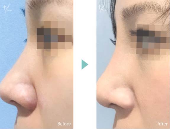 隆鼻術（プロテーゼ）の症例7