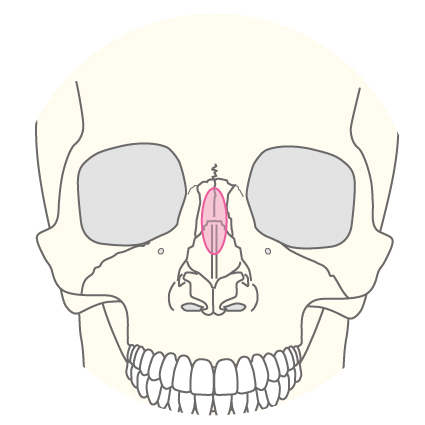 鼻骨骨切り術（鷲鼻修正）のイラスト1