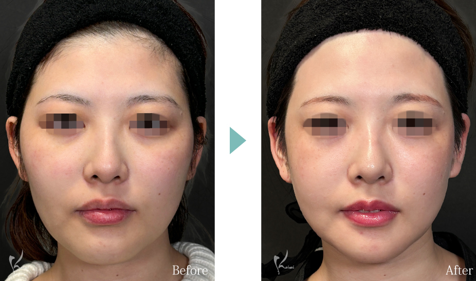 輪郭3点(頬・エラ・オトガイ骨切り)の症例1