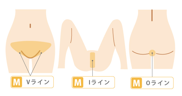 女性のSMLパーツ脱毛（施術部位）図解2