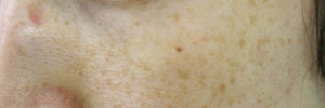 雀卵斑（そばかす）の症例写真