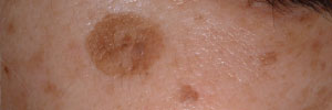 老人性色素斑の症例写真
