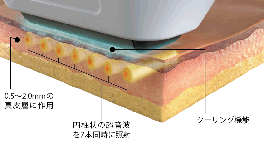 同期平行超音波照射の図解