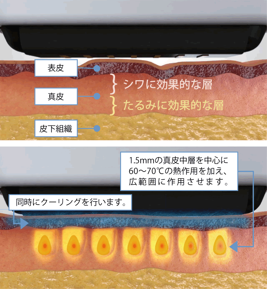 SUPERB™（スパーブ）作用の図解