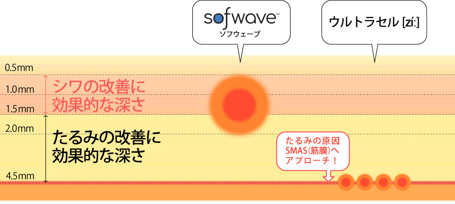 ウルトラウェーブの作用の図解