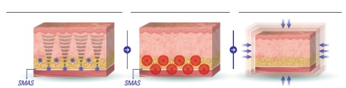 SMAS（筋膜）作用イメージ図解
